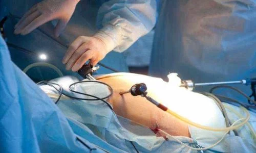 Laparoscopic-Surgery