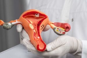 What are the causes of PCOS?