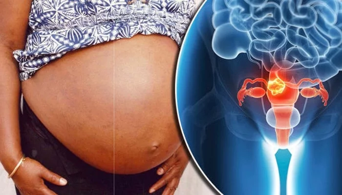 how-fibroids-affect-pregnancy