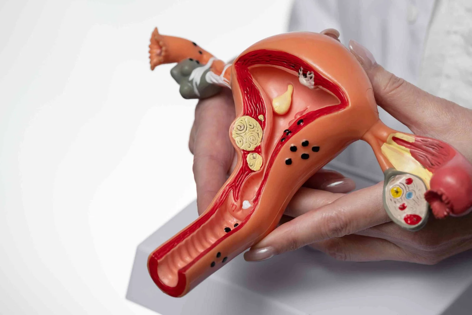 fibroids