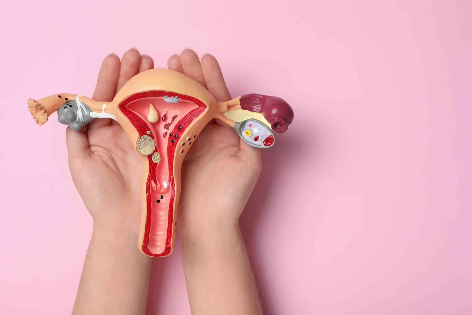 adenomyosis